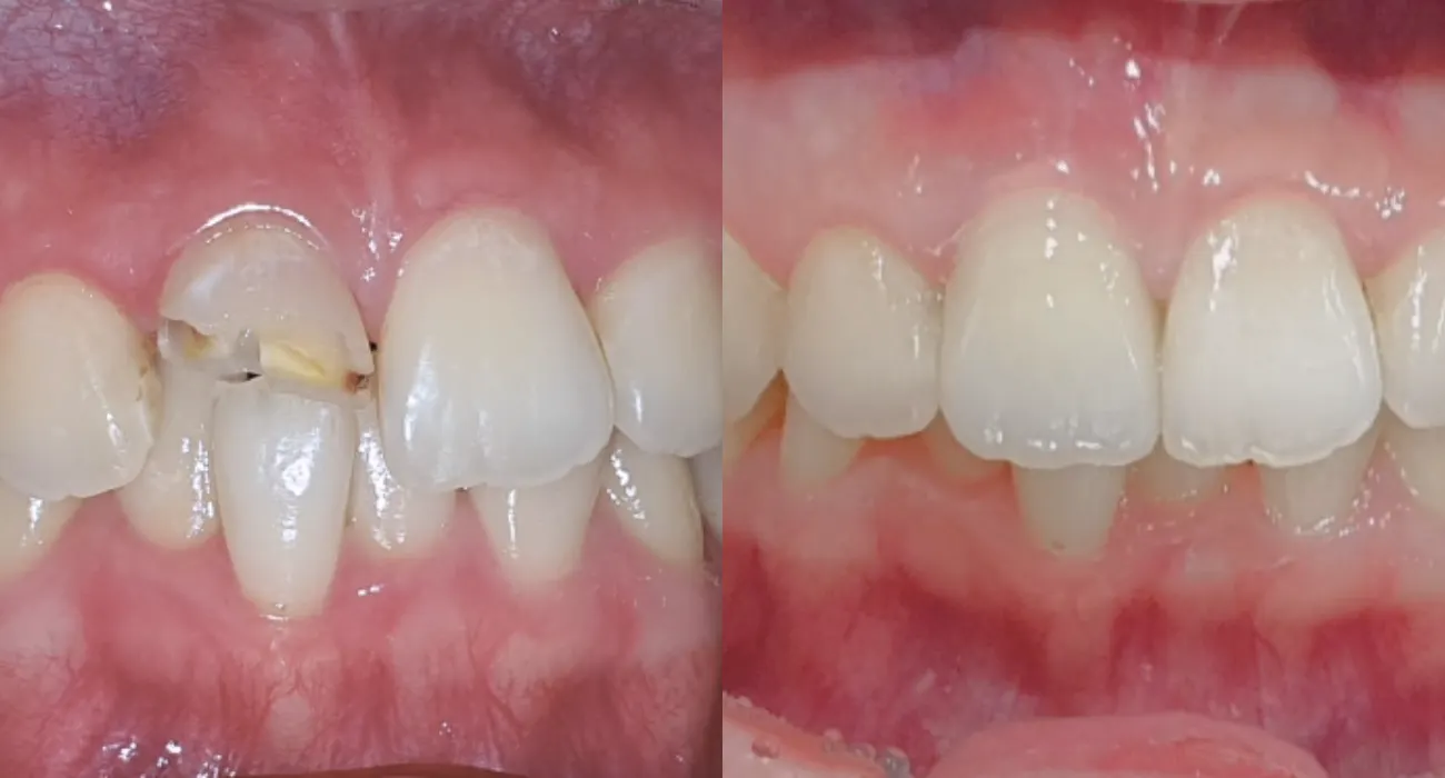 RCT & Restoration (보존/보철치료)