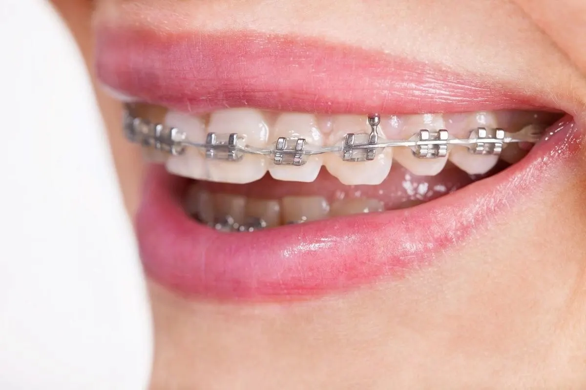 Orthodontics (교정치료)