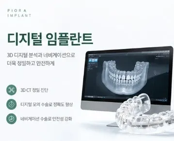 디지털 임플란트